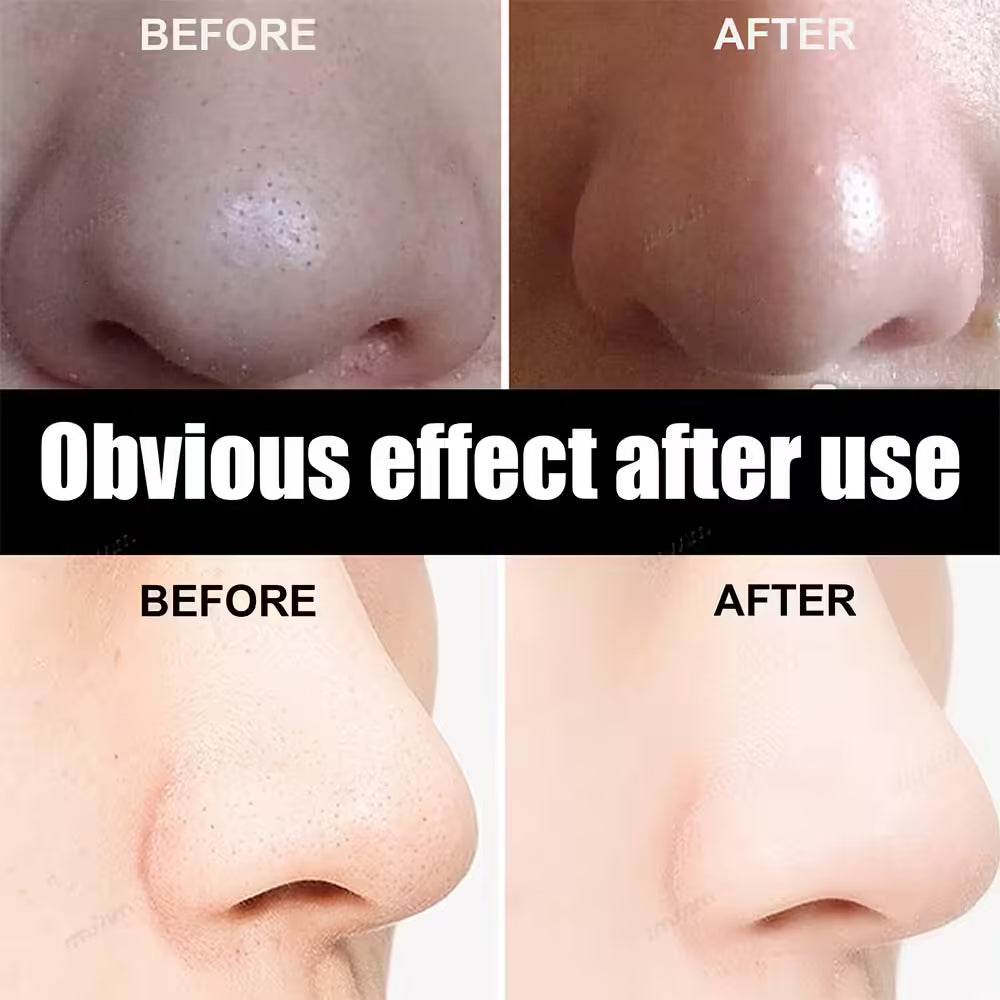 Unisex Blackhead Removal Mask Peel - Deep Cleansing Pore Nose Strips for Clear Skin - Skin Care Mask Patch