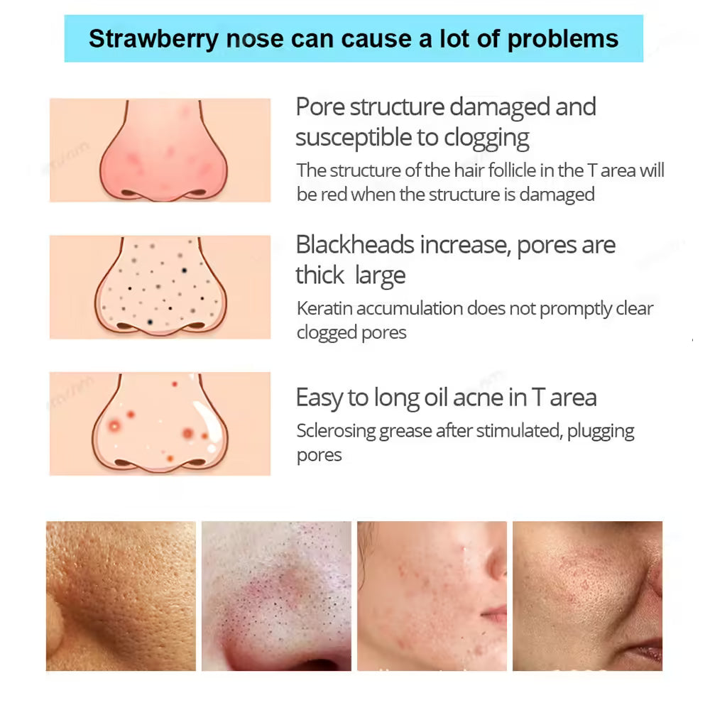 Unisex Blackhead Removal Mask Peel - Deep Cleansing Pore Nose Strips for Clear Skin - Skin Care Mask Patch