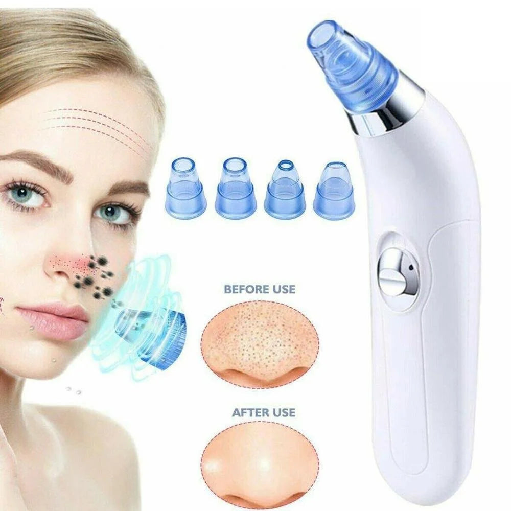 Derma Suction Blackhead Remover Vacuum – Electric Pore Cleaner with 4 Suction Heads for Acne, Whiteheads & Deep Facial Cleansing