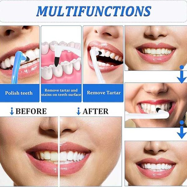 Advanced Tooth Stain Remover & Tartar Eraser Kit – Professional Dental Plaque Cleaning & Teeth Whitening Tool - Image 3